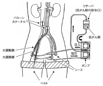 図1　日本医科大学式閉鎖循環下骨盤内灌流療法のしくみ