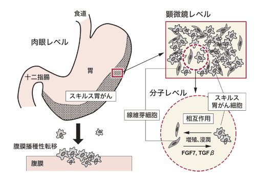 図：スキルス胃がんが進展していく過程