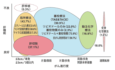 図：肝細胞がんに対する治療法の選択（日本）