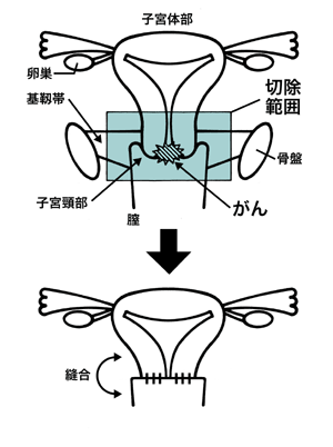 図：広汎性子宮頸部摘出術