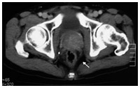 写真：がんの前立腺の被膜の外にはみ出した局所進行がんのT3症例