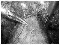 腹腔鏡下前立腺摘除術の図