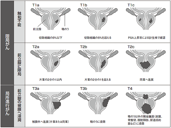前立腺がんのTNM分類