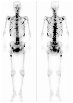 前立腺がん症例の骨シンチグラフィー写真