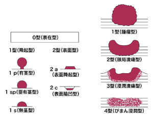 図：大腸がんの肉眼分類