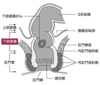 図：下部直腸がんの位置