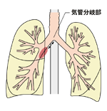 図：2B期　腫瘍の浸潤は気管分岐部から2センチ以上離れている