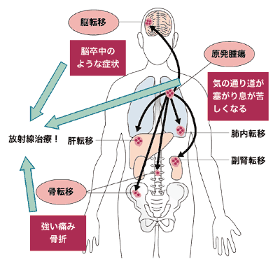 図：肺がんの主な転移・再発部位