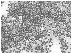 急性骨髄性白血病細胞