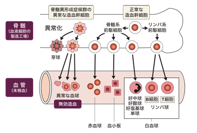 図：骨髄異形成症候群では正常な血液細胞ができない