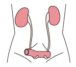 図：回腸導管