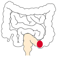 図：結腸ストーマ