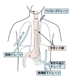 図：食道がんの手術例