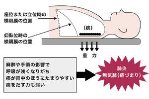 図：開胸・開腹術中や術後安静時の肺の状態