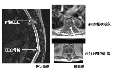 脊髄圧迫の症例（MRIの画像）
