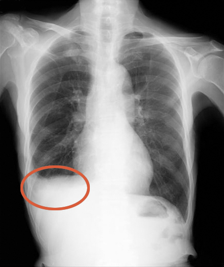 ■写真2 胸水の溜まった肺のレントゲン写真