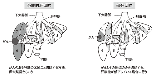 図5 「系統的肝切除」と「部分切除」