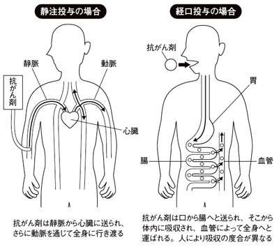 抗がん剤の投与方法