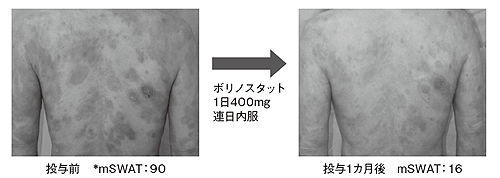 ボリノスタットの菌状息肉症に対する効果