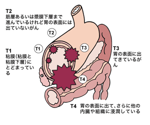 図：胃壁深達度（T1～T4）