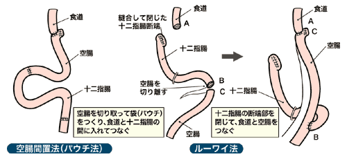 図：消胃全摘の場合の再建法