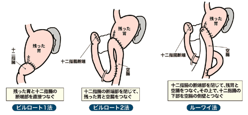 図：幽門側胃切除の場合の場合の再建法