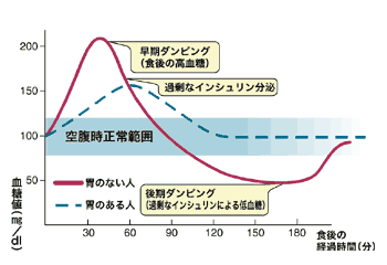 図：食事後の血糖値の変化（ダンピング症候群）