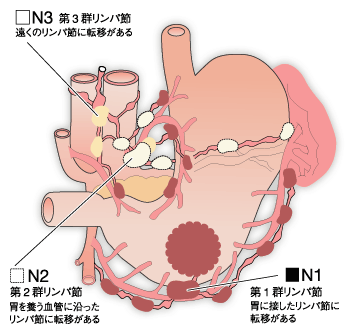 胃がんリンパ節の分類