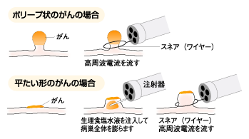 内視鏡的粘膜切除術の方法