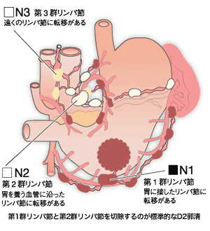 図:胃の周囲のリンパ節