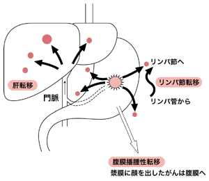 図:胃がんの転移の形式