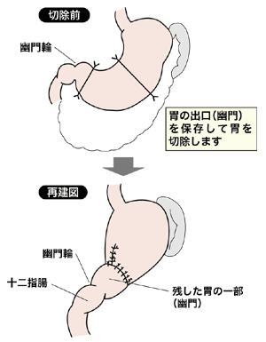 図：幽門保存胃切除術の方法