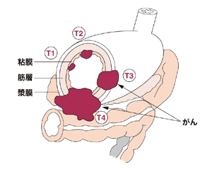 図:胃壁へのがんの深達度