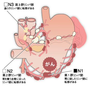 図:胃がんのリンパ節転移
