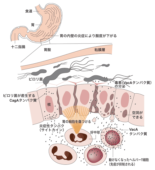 図：ピロリ菌が胃粘膜にもたらす悪影響の仕組み