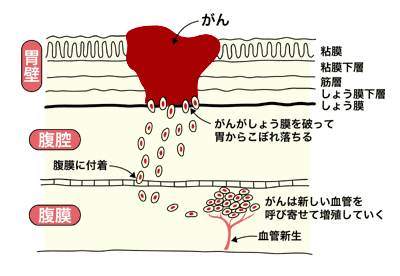 図：腹膜播種が生じる過程