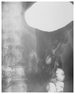 右下のあたりに腫瘍が見える