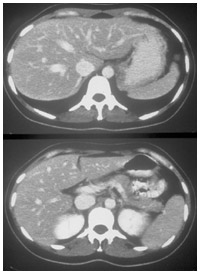 肝臓に2,3cm大の腫瘍が2個あったが、抗がん剤治療により消えた