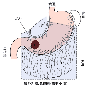 胃の亜全摘手術の範囲
