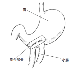 図2：外科的胃空腸吻合術（バイパス手術）