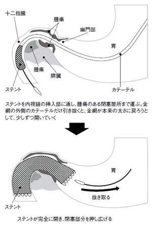 図4:ステント留置療法の仕組み