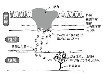図3：腹膜播種が生じる過程
