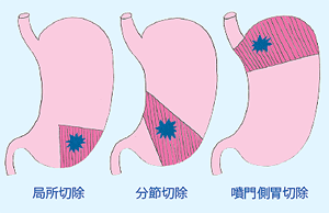 胃がんの部分切除、分節切除、噴門側胃切除