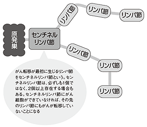 図5 センチネルリンパ節