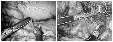 写真：左胃動脈周囲のリンパ節の郭清手術