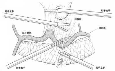 図：左胃動脈周囲のリンパ節の郭清手術