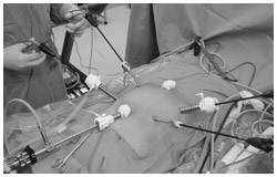 写真:腹腔鏡下手術の様子