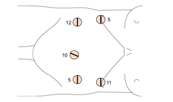 図：腹腔鏡下手術のための穴を開ける位置とサイズ