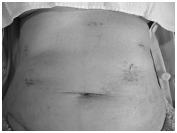 写真:腹腔鏡下手術で胃全摘した10日目の患者さんの手術跡