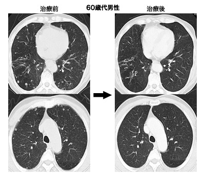 図:抗がん剤とインターフェロンの併用療法の効果